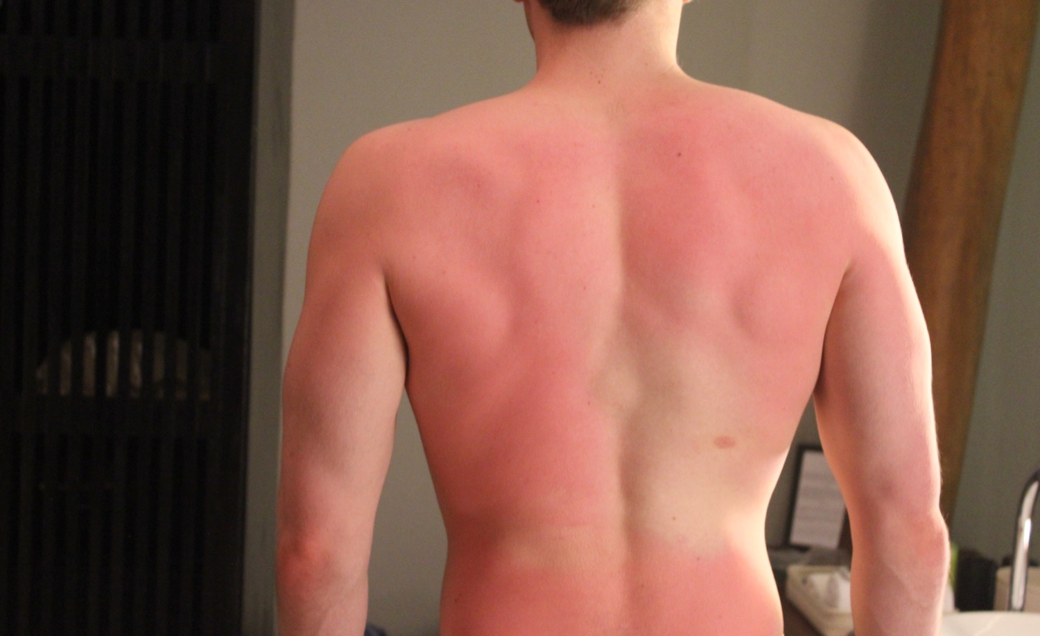 a man's back with red skin